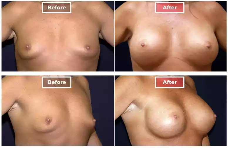 Breast Augmentation 4