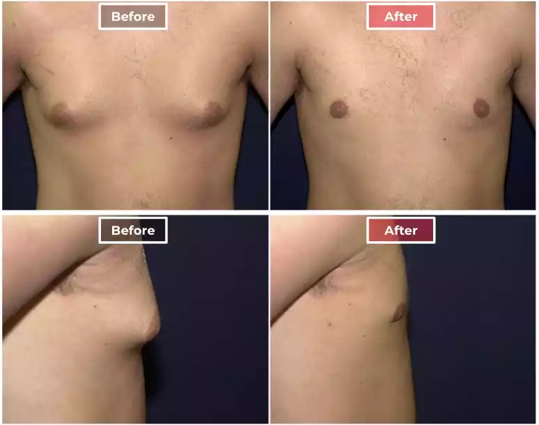 Male Breast Reduction 1