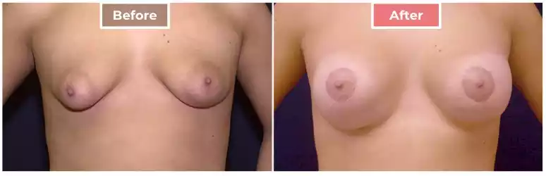 Breast Correction 1