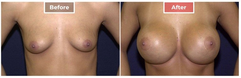 Breast Lift- Before and After - 2