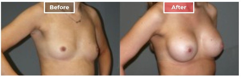 Breast Augmentation - before and after - 12