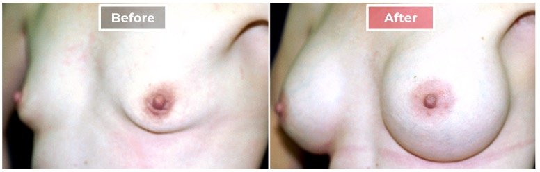 Breast Augmentation - before and after - 2