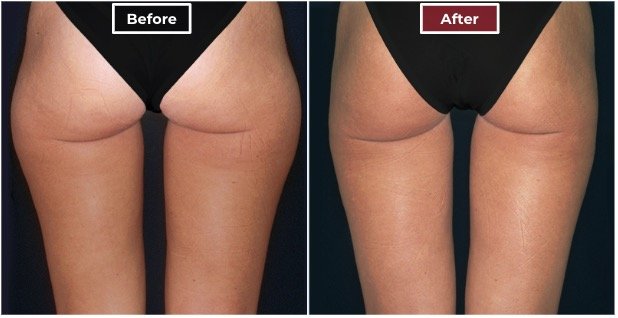 Liposuction treament before and after - 5