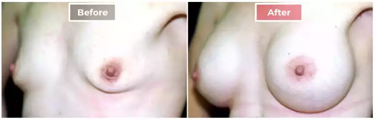 Breast Augmentation 2