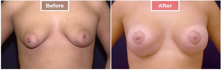 Breast Lift- Before and After