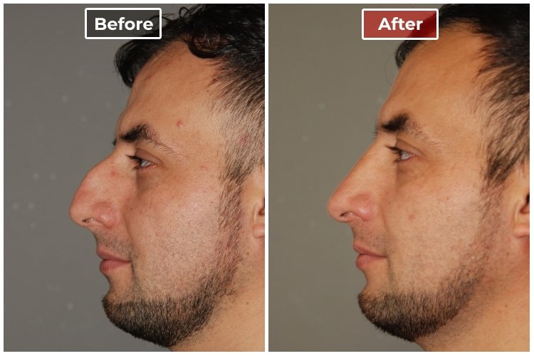 Rhinoplasty - before and after - 6
