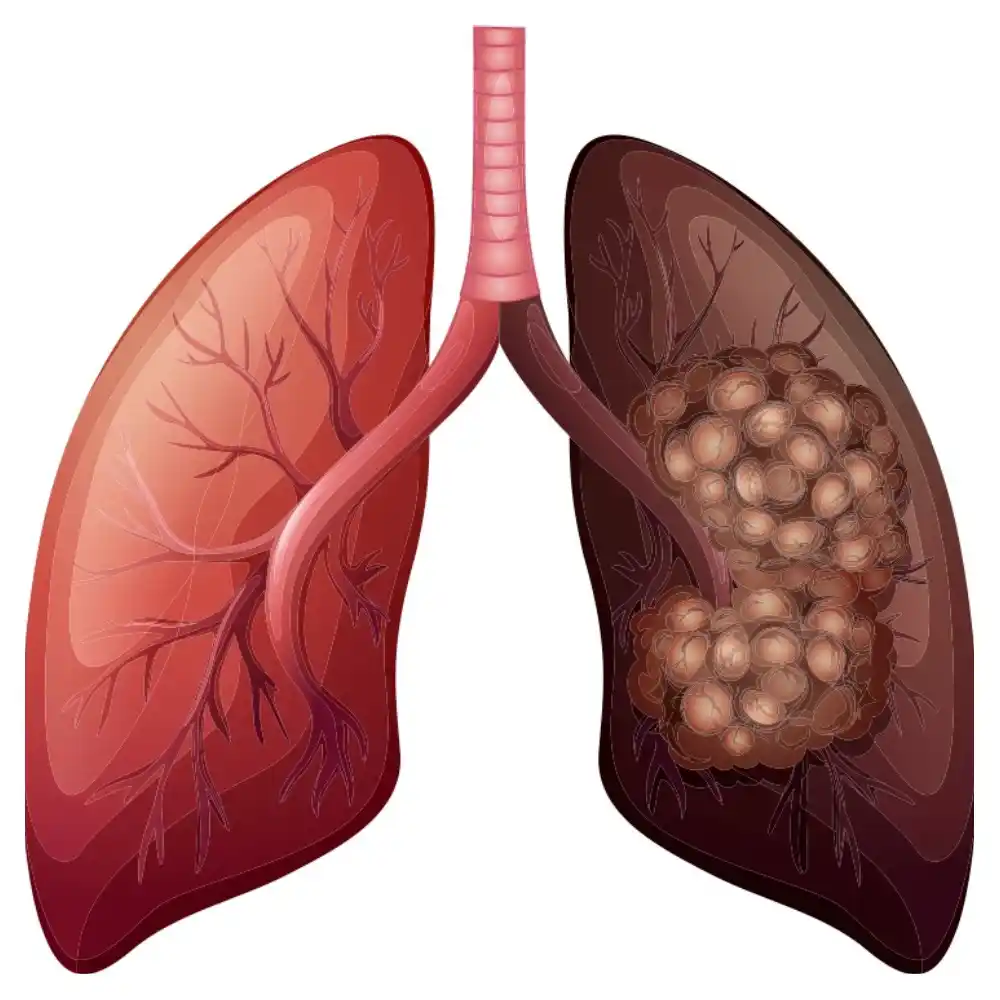 Lung Cancer in Lungs