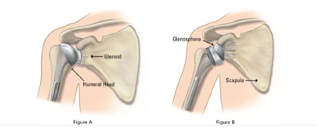 Shoulder Replacement Surgery