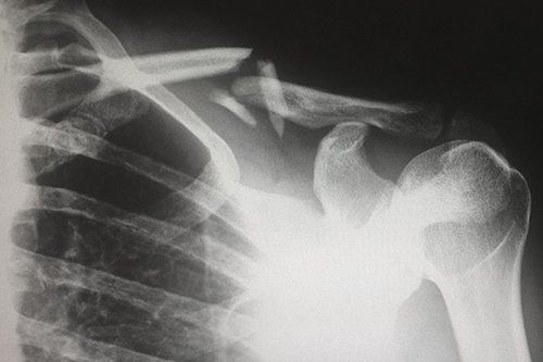 An X-Ray