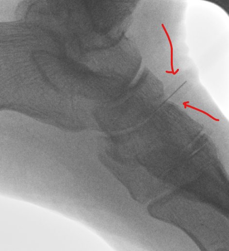 Achilles-Tendinopathy1.jpeg (Achilles-Tendinopathy1.webp)