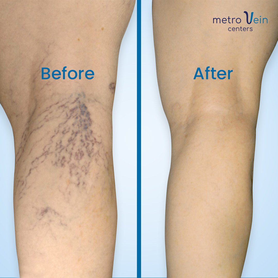 4 Things To Expect From Sclerotherapy Treatment