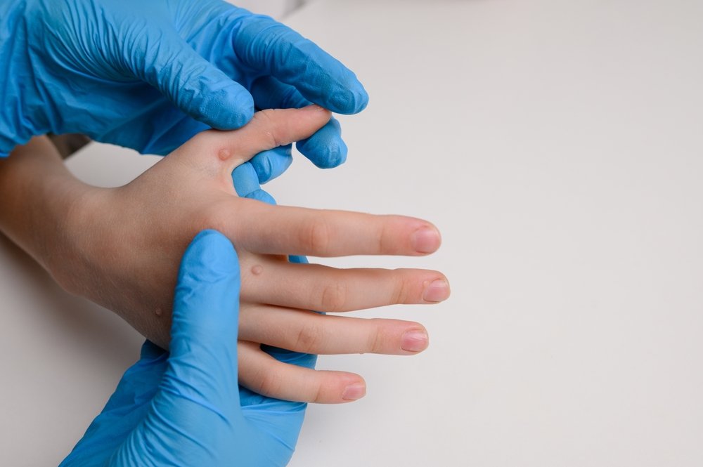 Doctor examines a child hand affected by viral warts Verruca vulgaris, close-up. Papillomavirus, HPV. Pediatric dermatology. Skin diseases. 