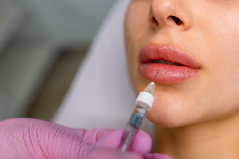 Injections for lips augmentation anti wrinkle injections on the face of a beautiful woman. Female aesthetic cosmetology in a beauty salon. Hematomas after lip contouring.