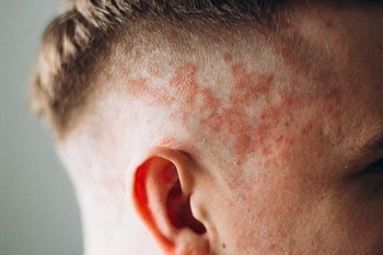 Psoriasis