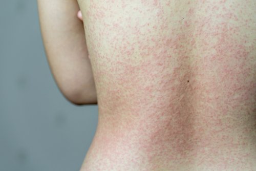 What does covid rash look like on a child