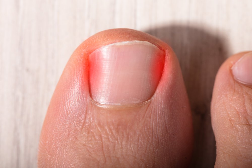 Ingrown Toe Nails – Gait Way Podiatry