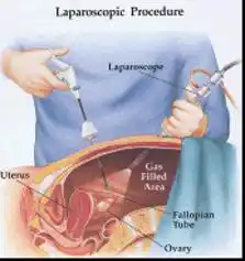 Laparoscopic Endometriosis Surgery