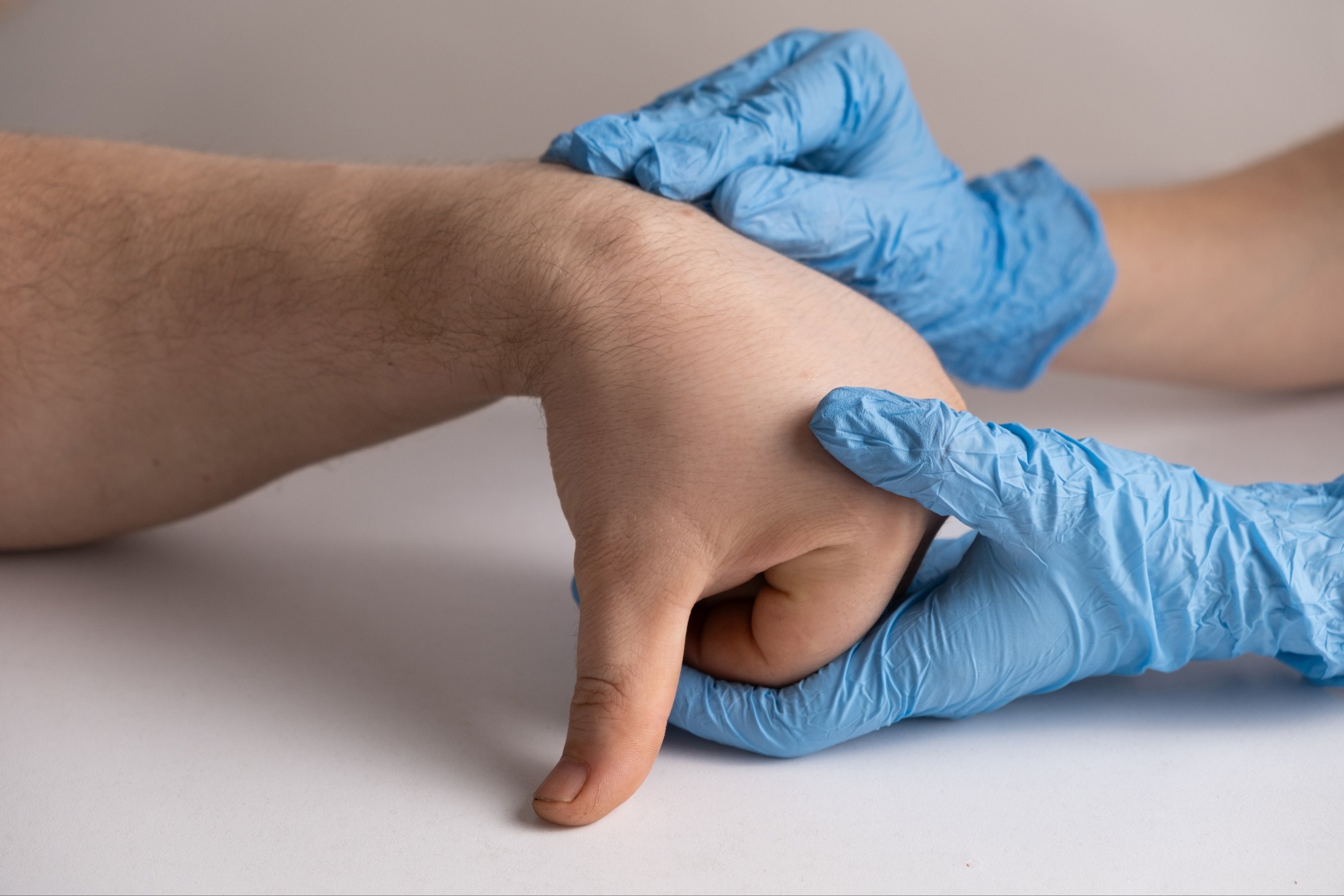 Ganglion cyst or hygroma of the wrist on the hand of a male patient