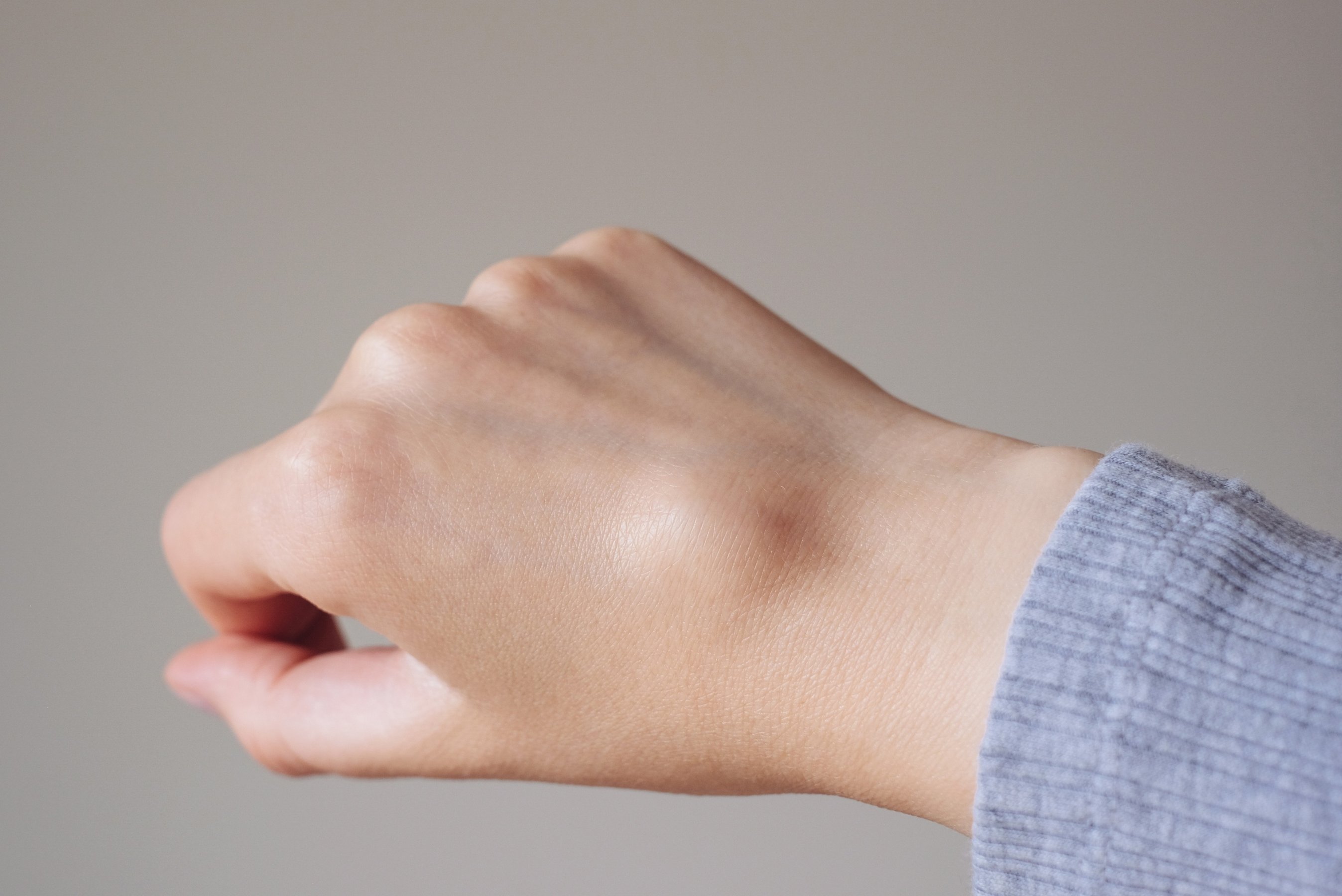 Female right back hand with ganglion cyst on the dorsum