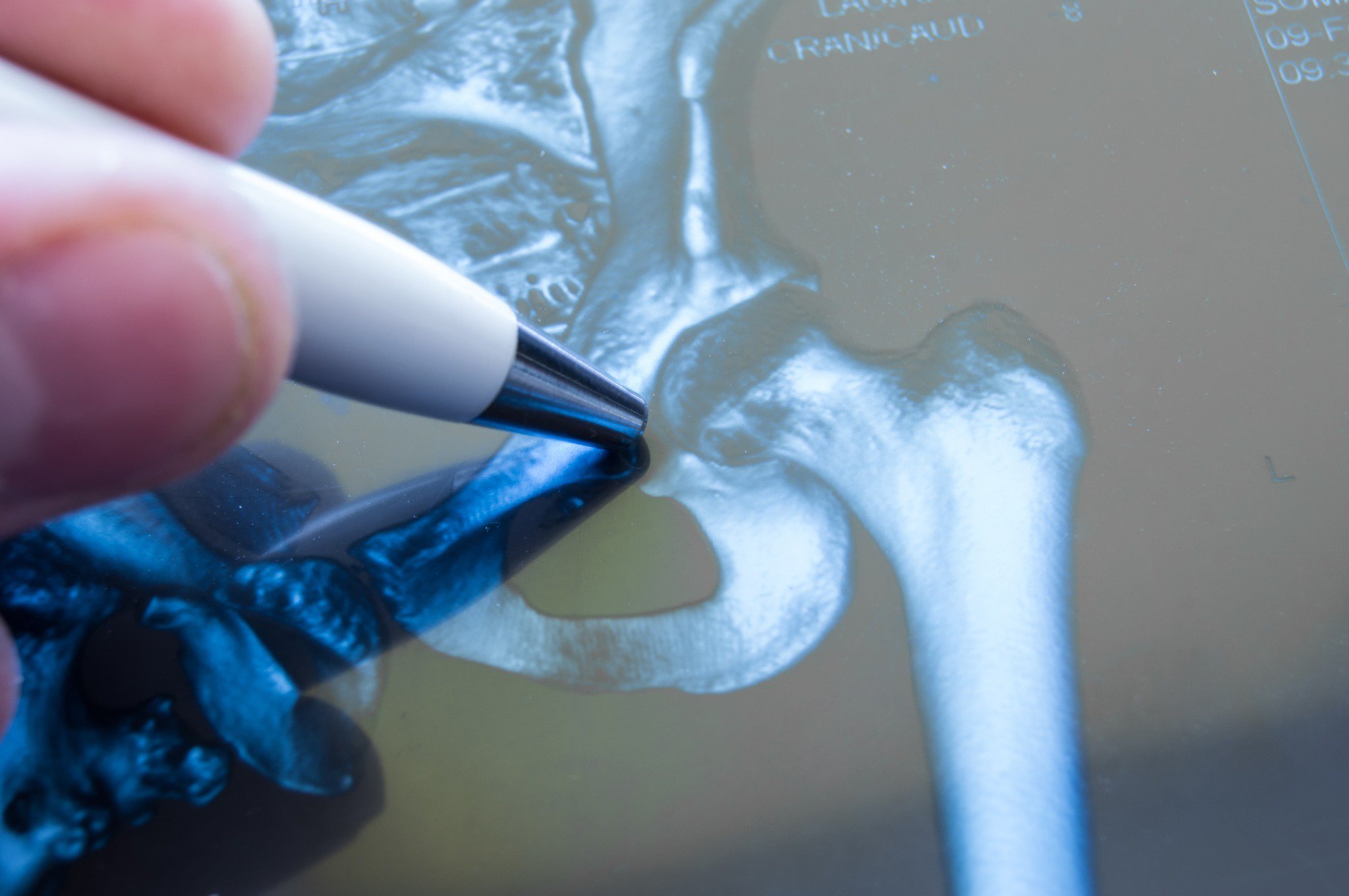 osteoarthritis hip replacement