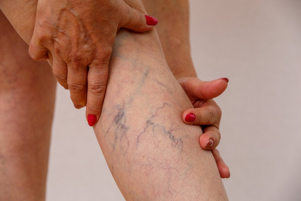 Prevention of Spider Veins