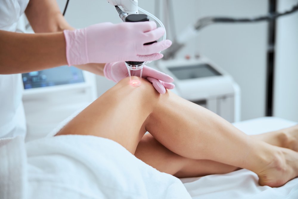 Varicose Veins Treatment