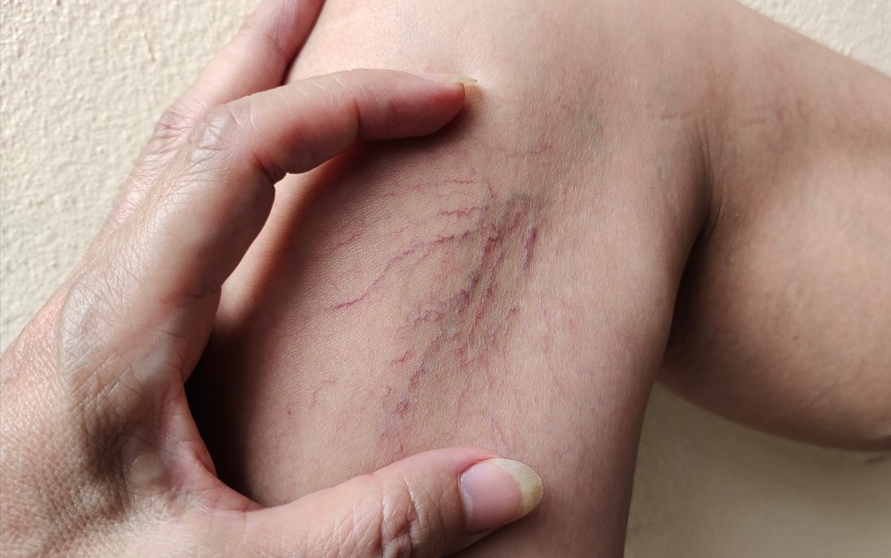 Spider Veins Treatment