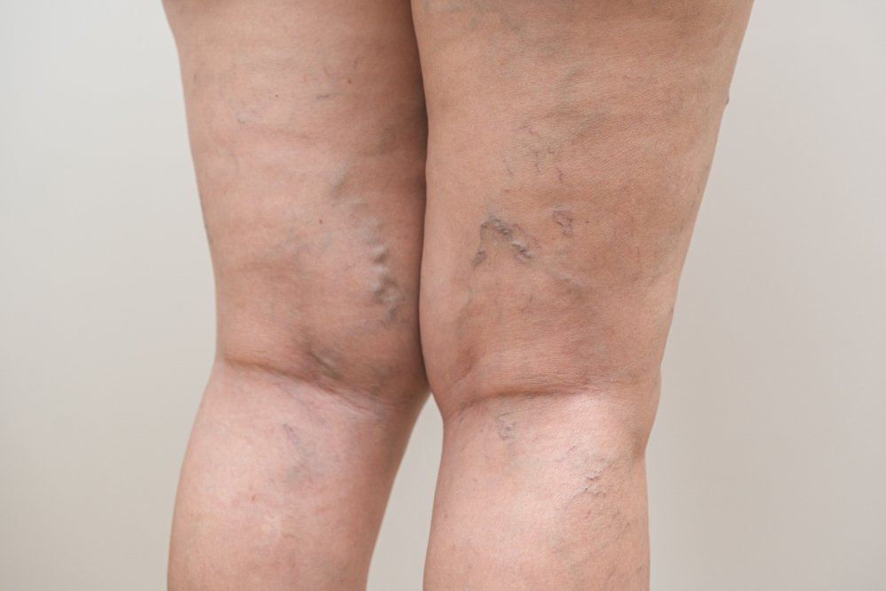 Spider Veins Treatment