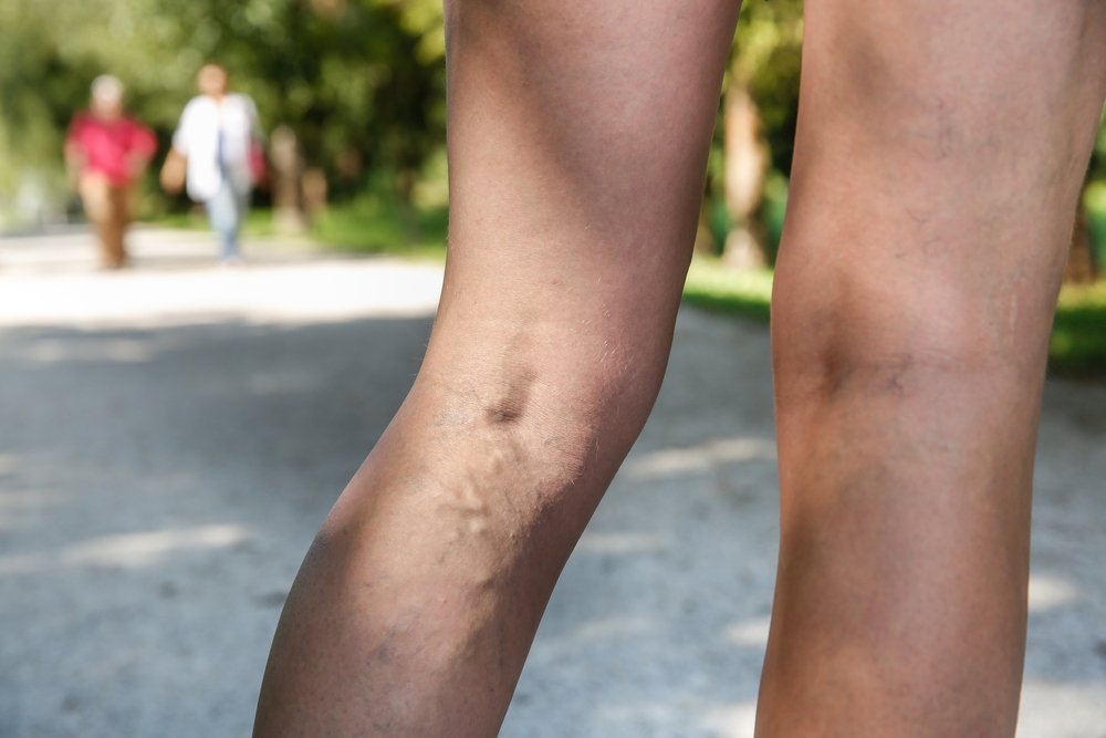 Varicose Veins Treatment