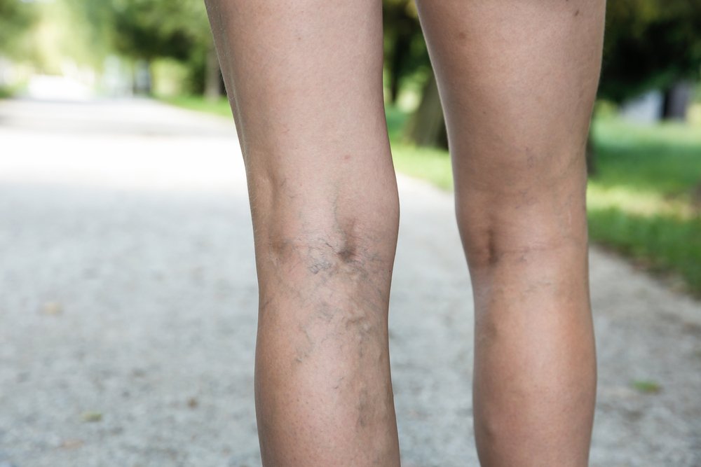 Varicose Veins Treatment