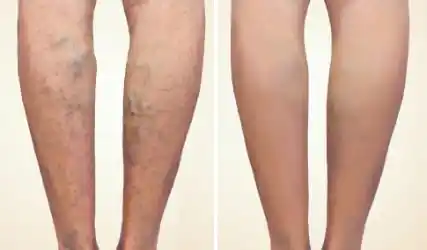 Before and After Legs One
