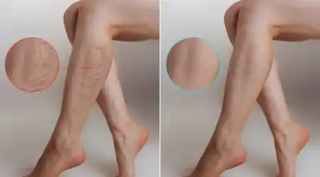 Before and After Legs Two