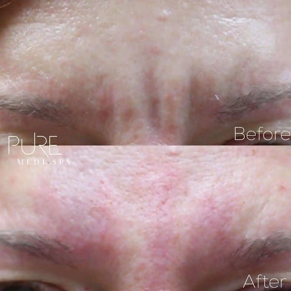 Injectables MEDI Spa Before and After Ten