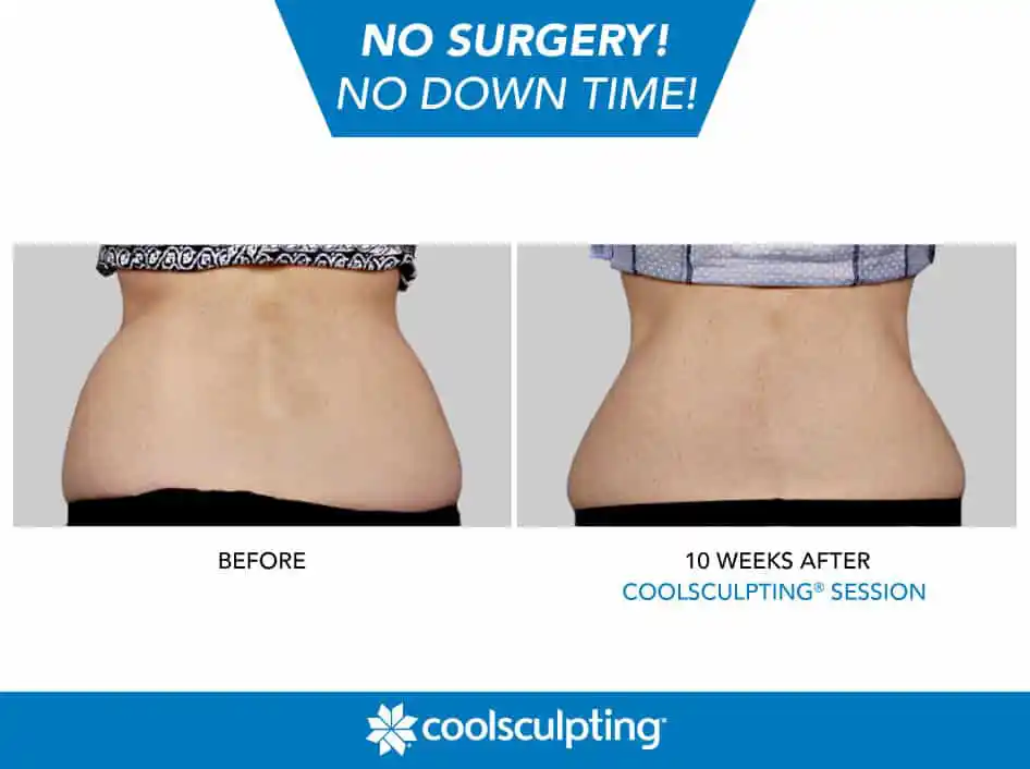 Coolsculpting Before and After One