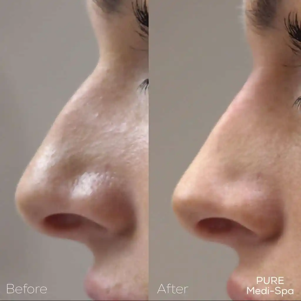 Injectables MEDI Spa Before and After Seven