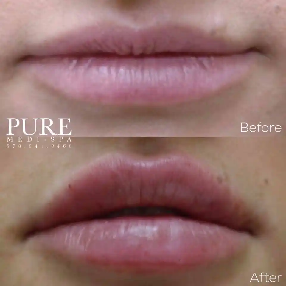 Injectables MEDI Spa Before and After Two