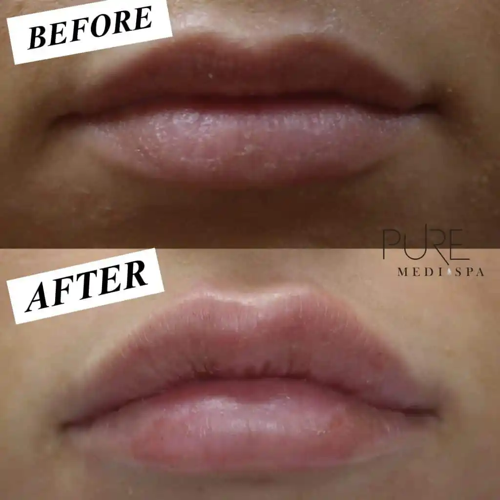 Injectables MEDI Spa Before and After Eight