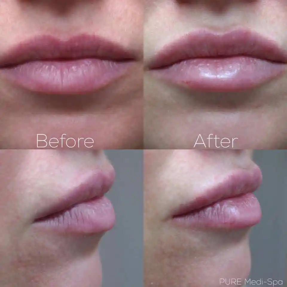 Injectables MEDI Spa Before and After Fifteen