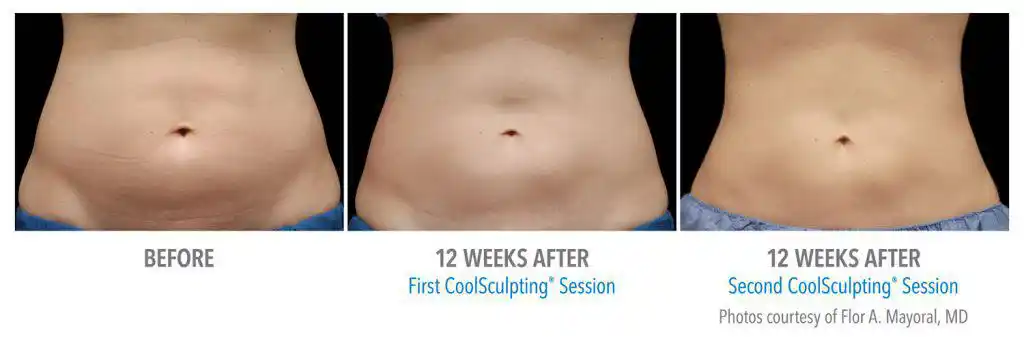 2 Coolsculpting Session Before and After Four