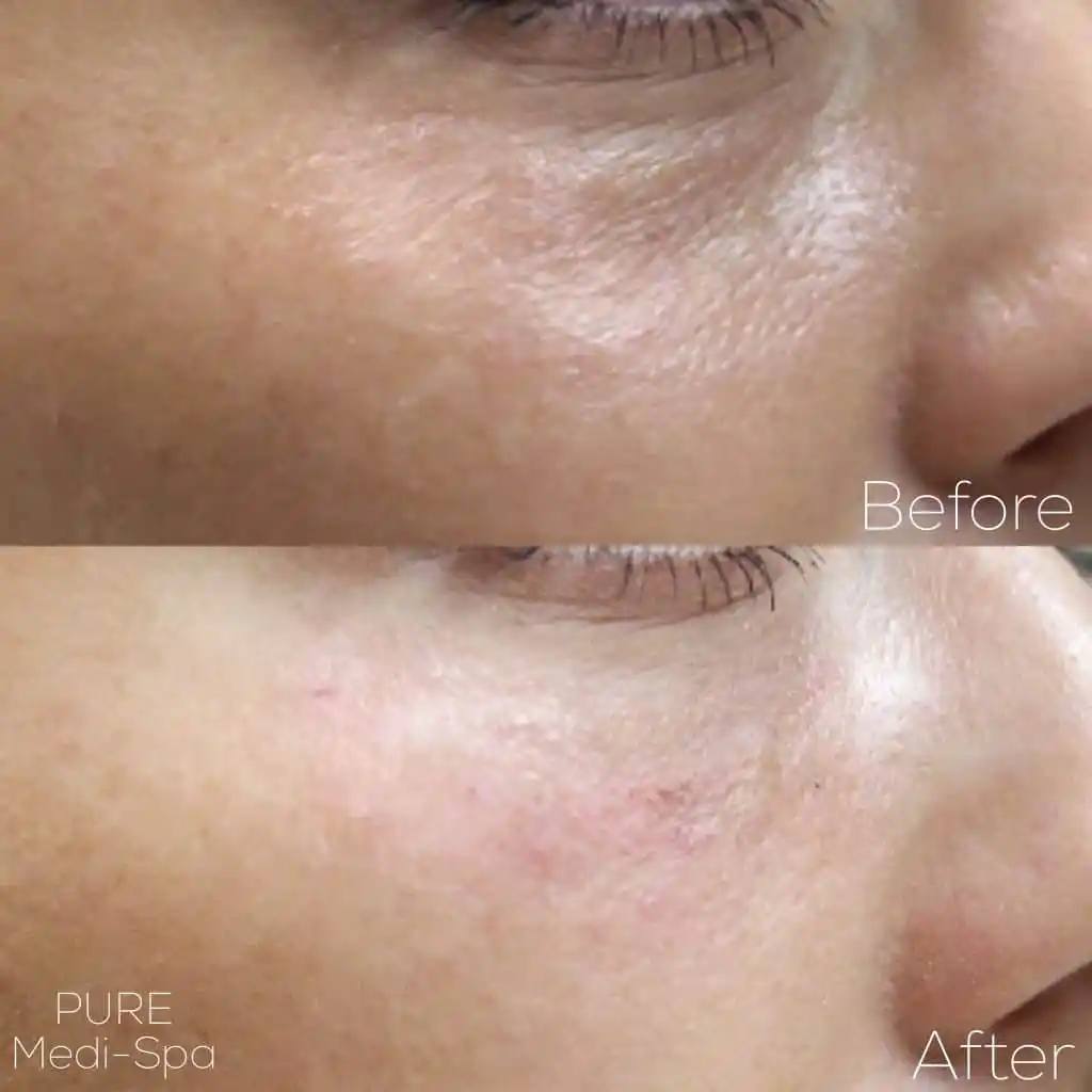 Injectables MEDI Spa Before and After Six