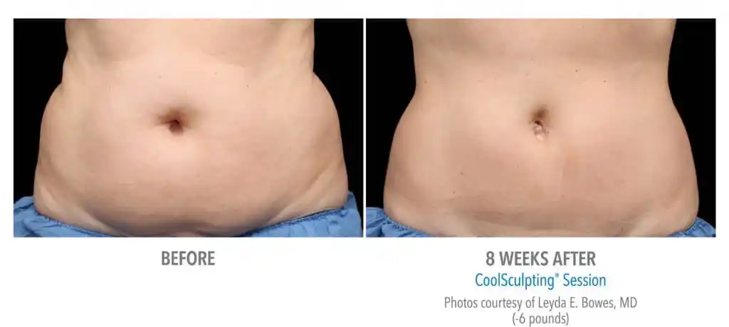 Coolsculpting Before and After Eight