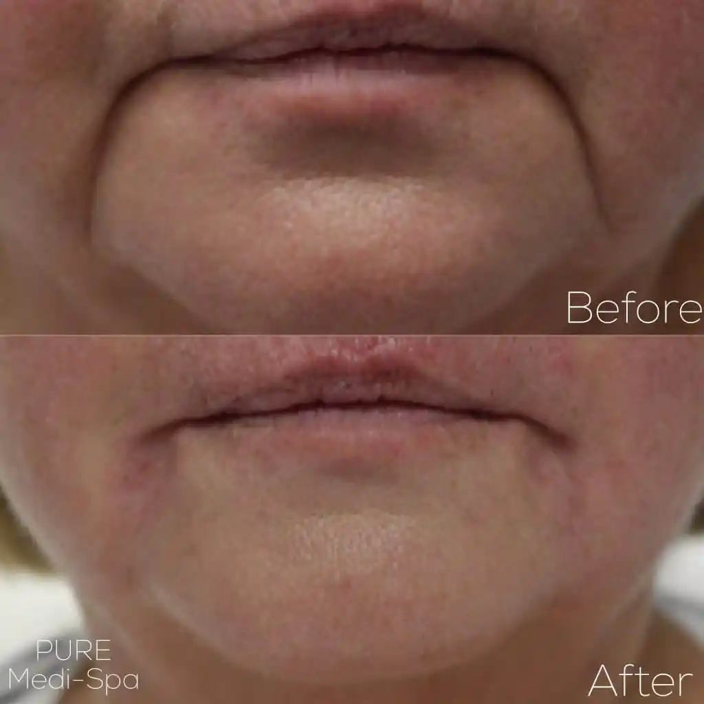 Injectables MEDI Spa Before and After One