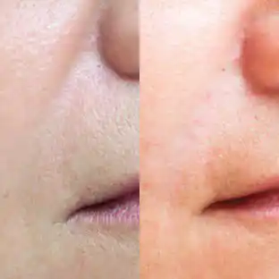Injectables MEDI Spa Before and After Twelve