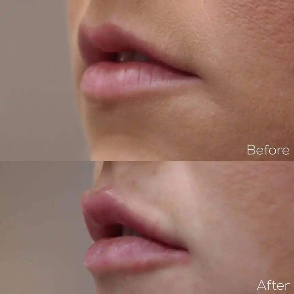 Injectables MEDI Spa Before and After Seventeen