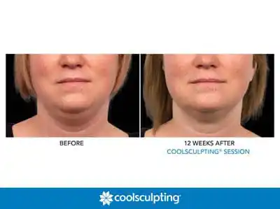 Coolsculpting Before and After Three