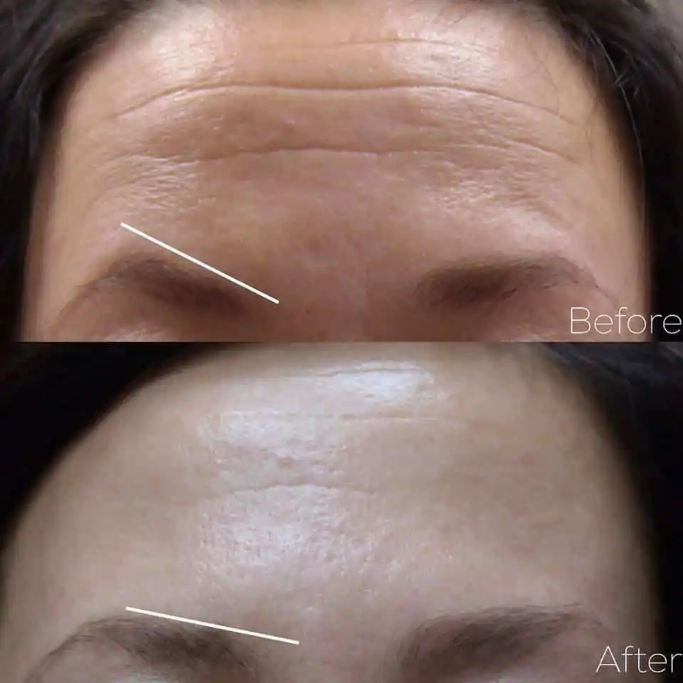 Injectables MEDI Spa Before and After Sixteen