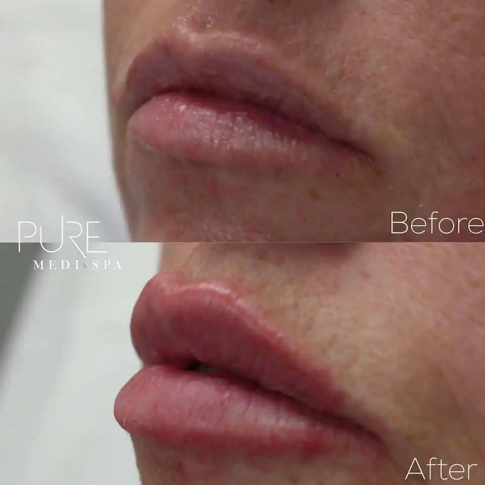 Injectables MEDI Spa Before and After Nine