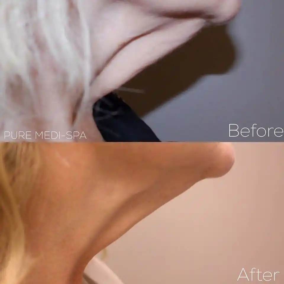 Injectables MEDI Spa Before and After Fourteen