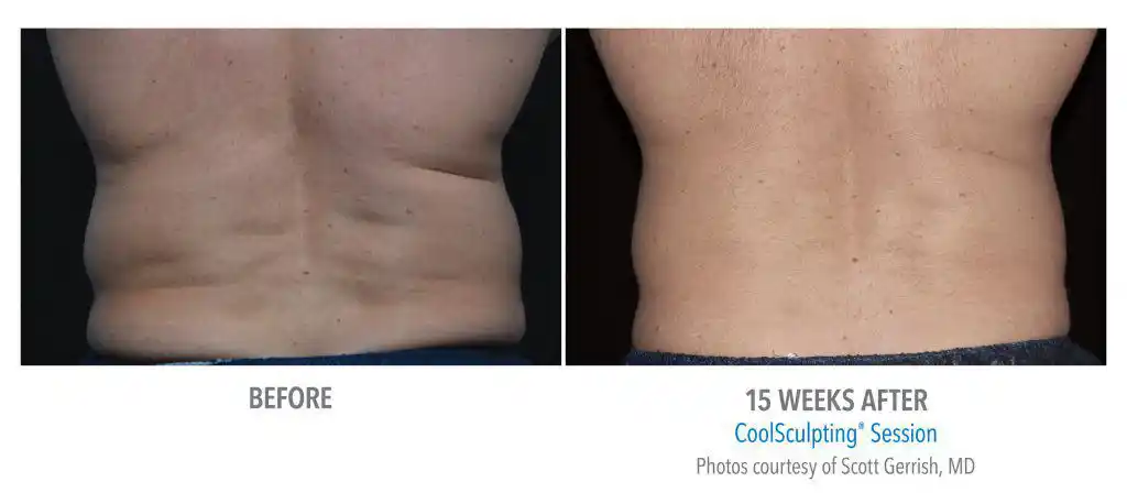 Coolsculpting Before and After Five