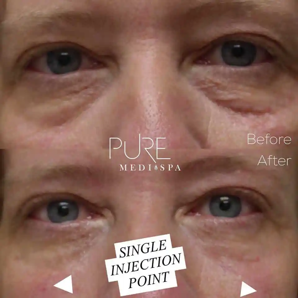 Injectables MEDI Spa Before and After Four